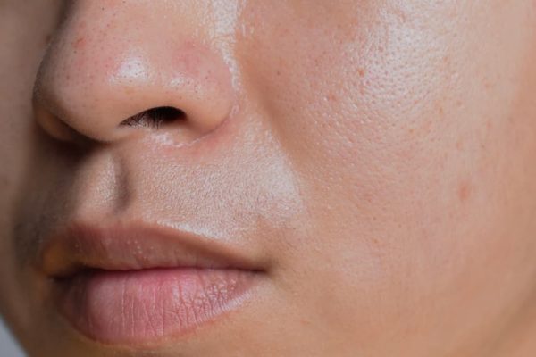 Tips Ampuh Mengatasi Kulit Berminyak agar Bebas Kilap Seharian