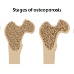 Cara Mudah Cegah Osteoporosis: Tips untuk Kesehatan Tulang