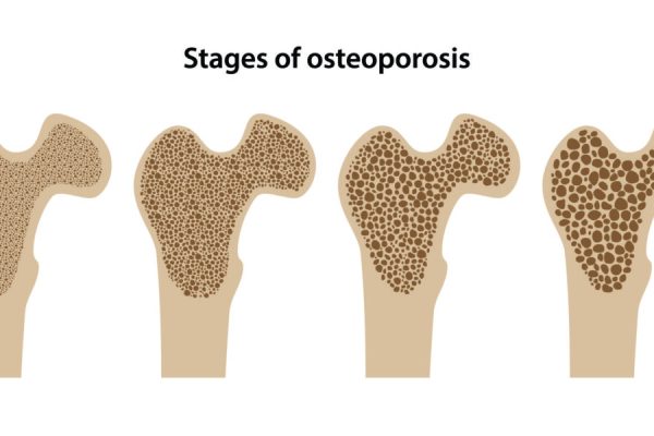 Cara Mudah Cegah Osteoporosis: Tips untuk Kesehatan Tulang