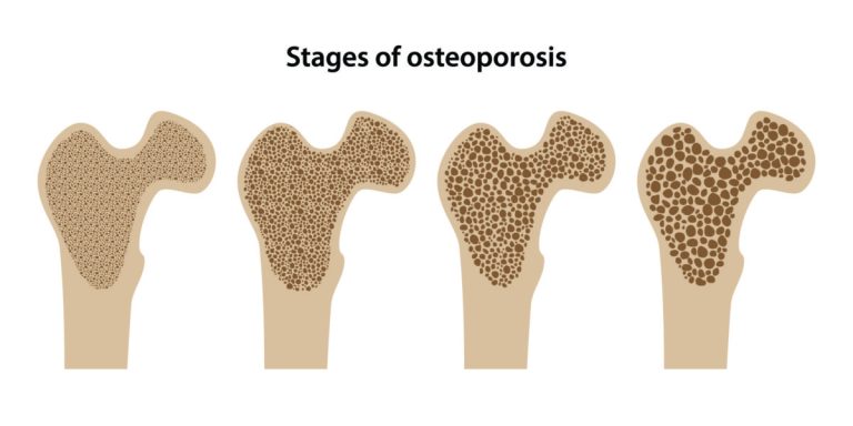 Cara Mudah Cegah Osteoporosis: Tips untuk Kesehatan Tulang