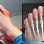 5 Tips Menurunkan Risiko Gout yang Dapat Merusak Sendi