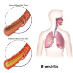 10 Tips Mengurangi Risiko Bronkitis dengan Gaya Hidup Sehat