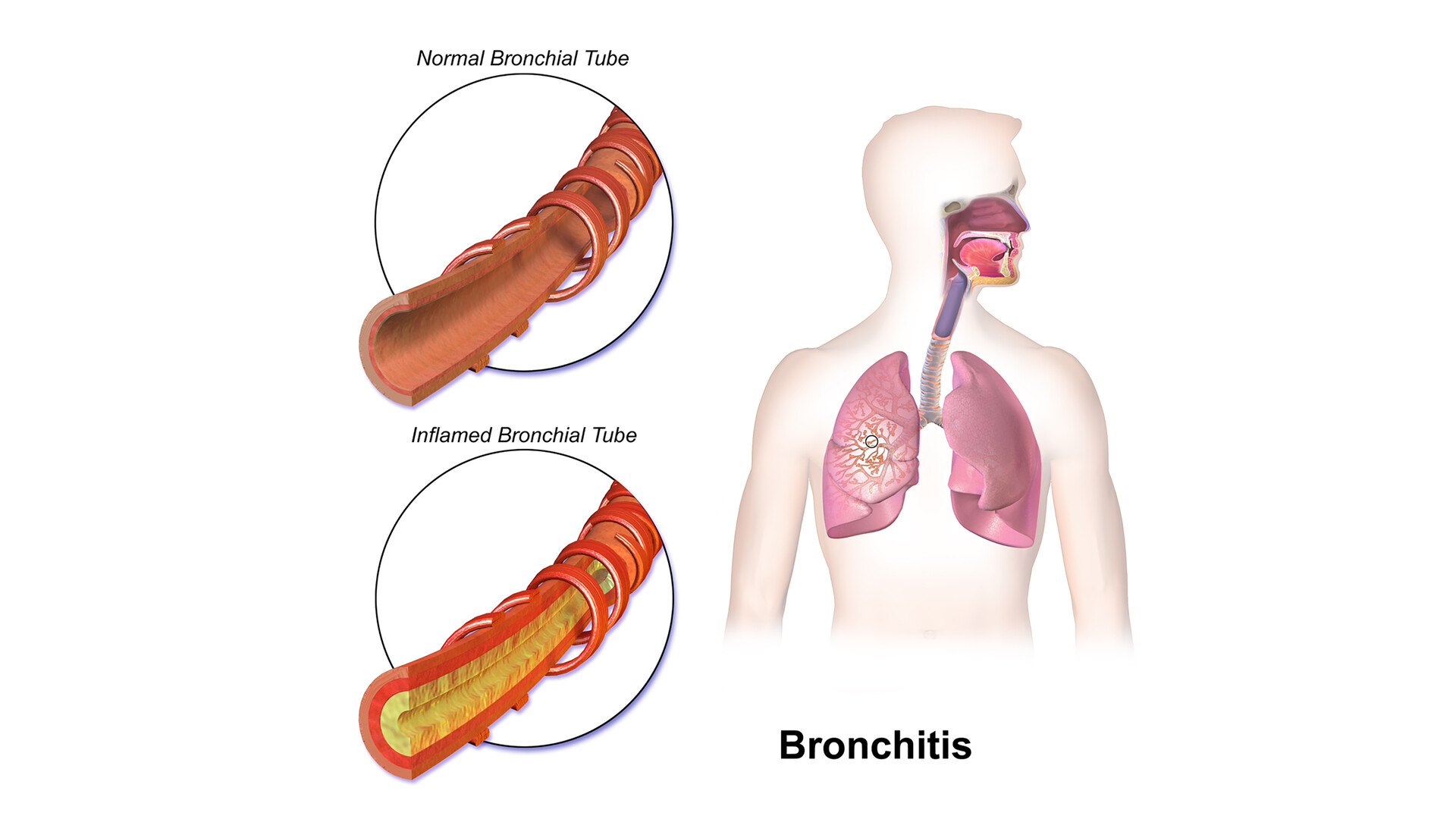 10 Tips Mengurangi Risiko Bronkitis dengan Gaya Hidup Sehat