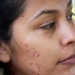 5 Cara Sederhana Mengatasi Bekas Jerawat dengan Bahan Alami