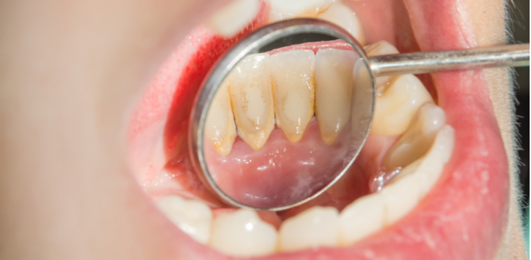 7 Cara Mencegah Karang Gigi Menumpuk